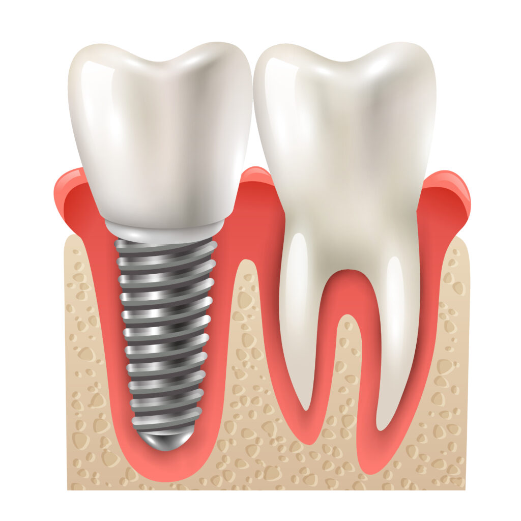 Implante dentário