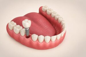 Perdi um dente